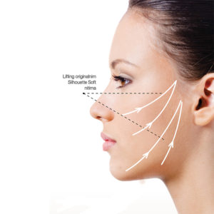 Silhouette Soft Niti – Akcija!